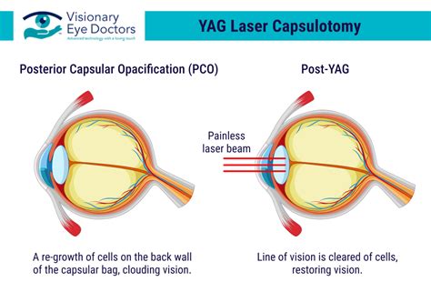 YAG Laser Surgery .